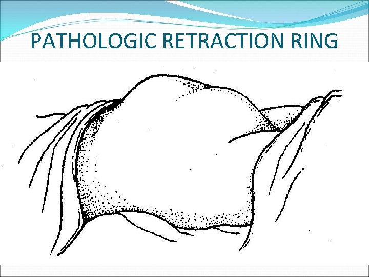 PATHOLOGIC RETRACTION RING 