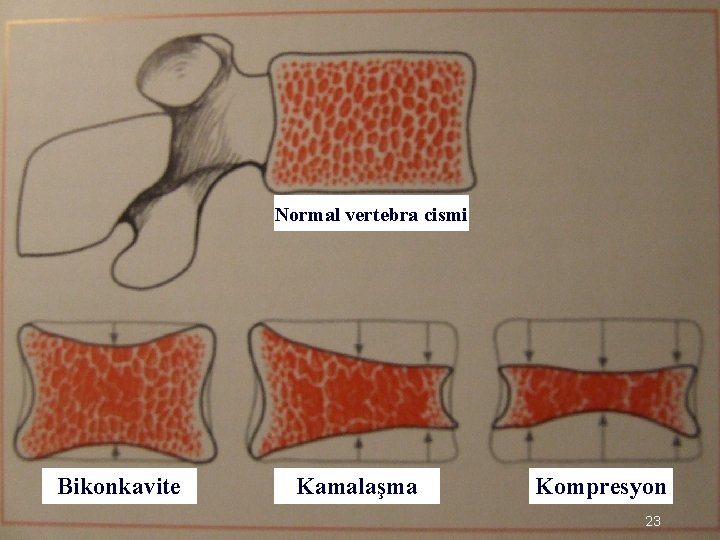 Normal vertebra cismi Bikonkavite Kamalaşma Kompresyon 23 