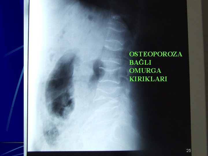 OSTEOPOROZA BAĞLI OMURGA KIRIKLARI 25 