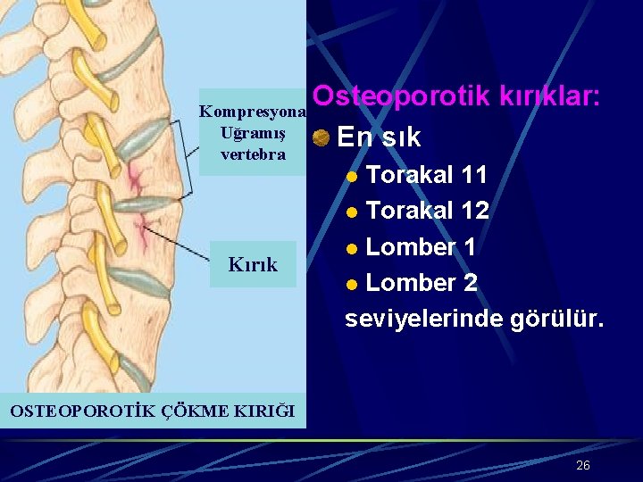 Kompresyona Uğramış vertebra Osteoporotik kırıklar: En sık Torakal 11 l Torakal 12 l Lomber