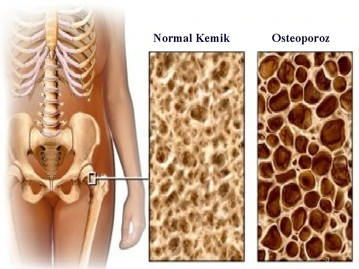 Normal Kemik Osteoporoz 3 