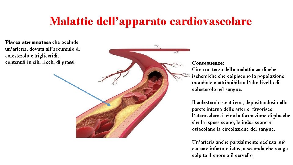 Malattie dell’apparato cardiovascolare Placca ateromatosa che occlude un’arteria, dovuta all’accumulo di colesterolo e trigliceridi,