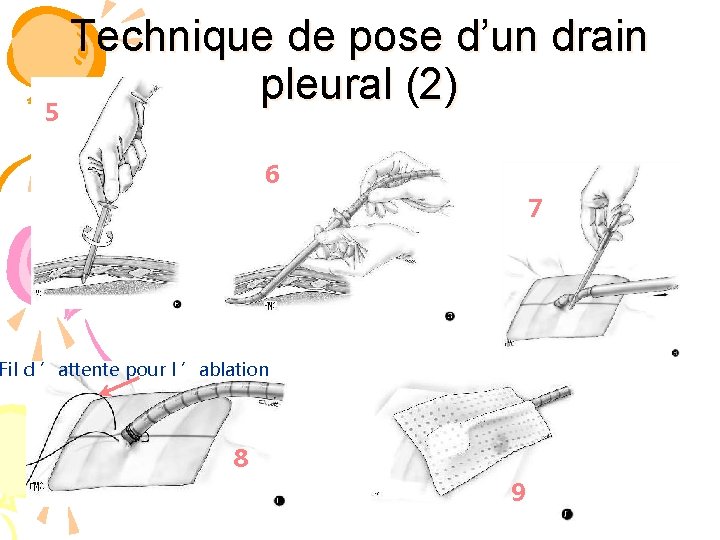 Technique de pose d’un drain pleural (2) 5 6 7 Incision Fil d ’attente
