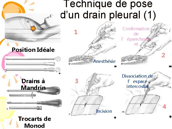 Technique de pose d’un drain pleural (1) Confirmation de l’épancheme nt 1 Position Idéale