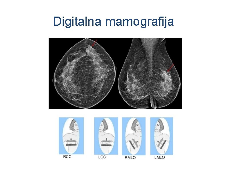 Digitalna mamografija 