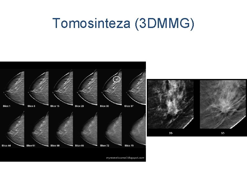 Tomosinteza (3 DMMG) 