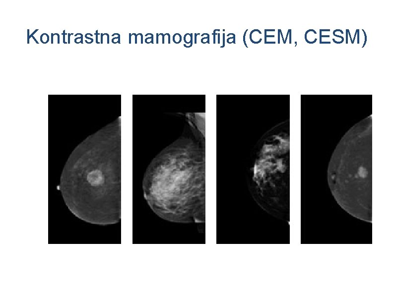 Kontrastna mamografija (CEM, CESM) 