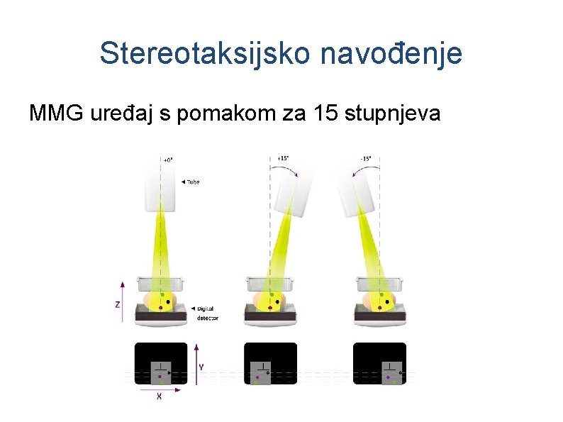 Stereotaksijsko navođenje MMG uređaj s pomakom za 15 stupnjeva 