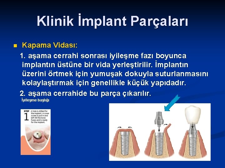 Klinik İmplant Parçaları n Kapama Vidası: 1. aşama cerrahi sonrası iyileşme fazı boyunca implantın