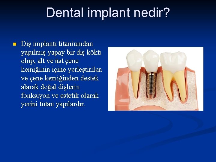 Dental implant nedir? n Diş implantı titaniumdan yapılmış yapay bir diş kökü olup, alt