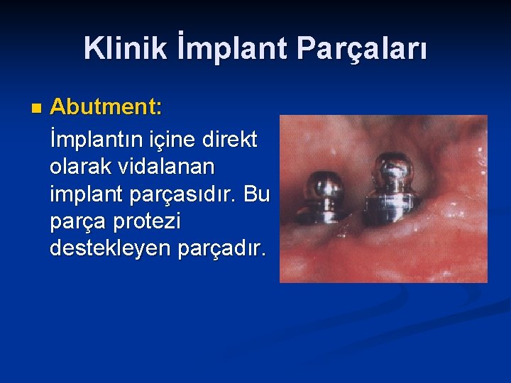 Klinik İmplant Parçaları n Abutment: İmplantın içine direkt olarak vidalanan implant parçasıdır. Bu parça