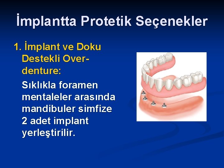 İmplantta Protetik Seçenekler 1. İmplant ve Doku Destekli Overdenture: Sıklıkla foramen mentaleler arasında mandibuler