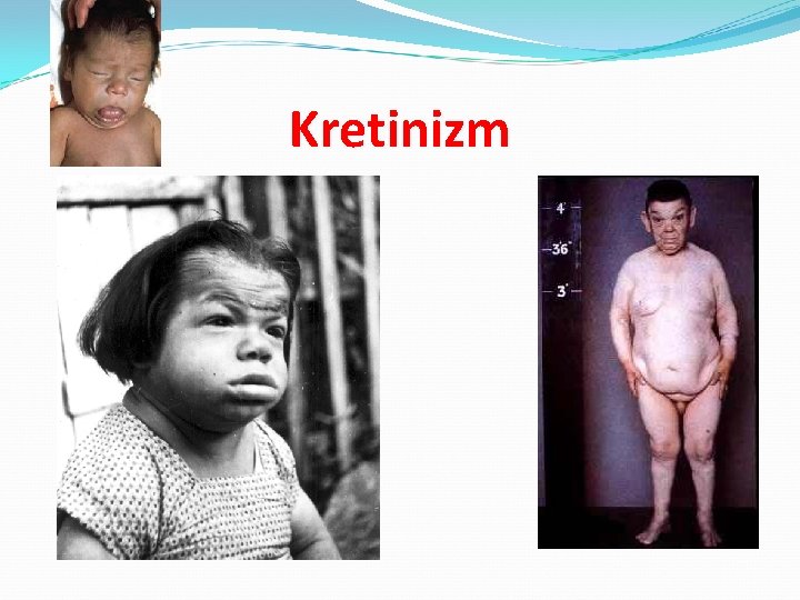 Kretinizm 