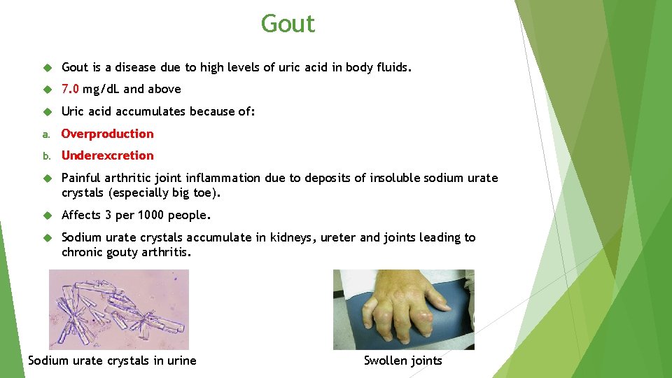 Gout is a disease due to high levels of uric acid in body fluids.