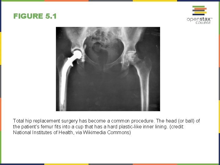 FIGURE 5. 1 Total hip replacement surgery has become a common procedure. The head