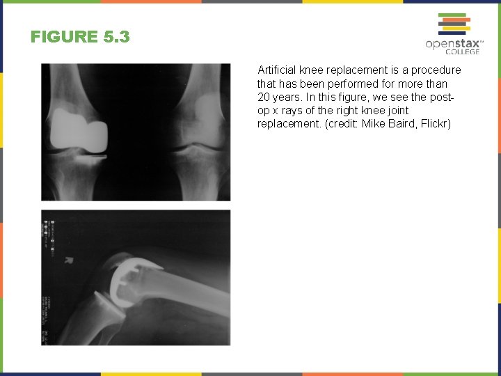 FIGURE 5. 3 Artificial knee replacement is a procedure that has been performed for