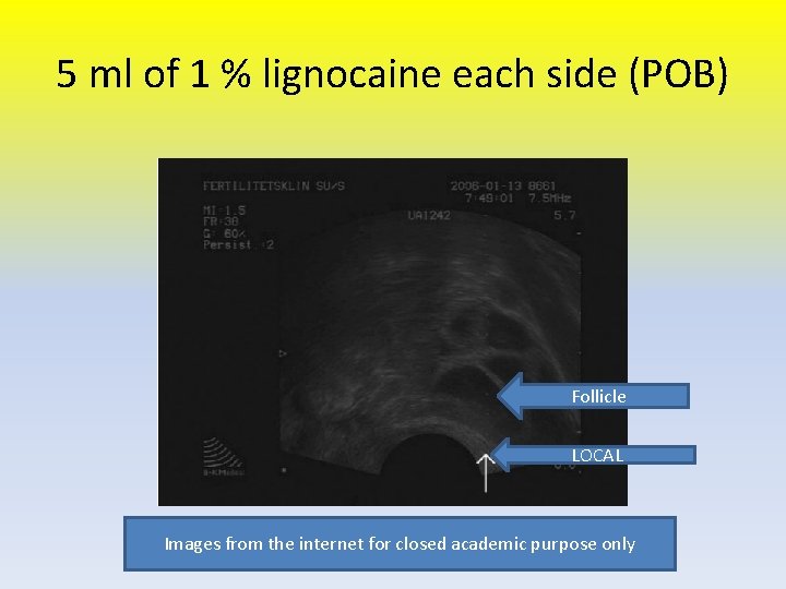 5 ml of 1 % lignocaine each side (POB) Follicle LOCAL Images from the