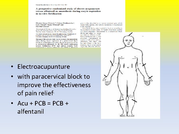  • Electroacupunture • with paracervical block to improve the effectiveness of pain relief.