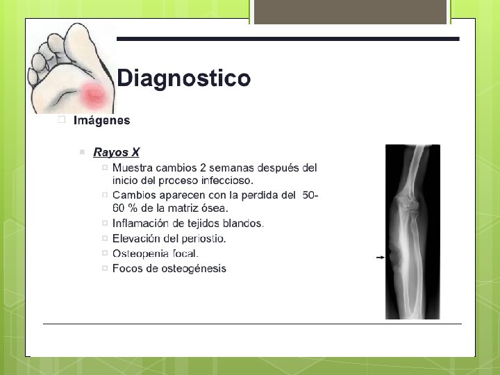 Radiología: No mostrara síntomas óseos hasta pasado 1 o 2 semanas Radiología: No mostrara síntomas óseos hasta pasado 1 o 2 semanas