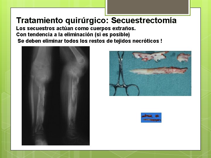Tratamiento quirúrgico: Secuestrectomía Los secuestros actúan como cuerpos extraños. Con tendencia a la eliminación Tratamiento quirúrgico: Secuestrectomía Los secuestros actúan como cuerpos extraños. Con tendencia a la eliminación