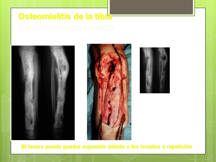 Osteomielitis de la tibia Desbridamiento intenso El hueso puede quedar expuesto debido a los Osteomielitis de la tibia Desbridamiento intenso El hueso puede quedar expuesto debido a los