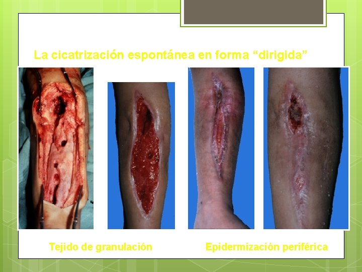 La cicatrización espontánea en forma “dirigida” Tejido de granulación Epidermización periférica La cicatrización espontánea en forma “dirigida” Tejido de granulación Epidermización periférica