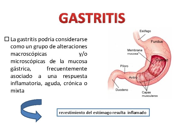 GASTRITIS La gastritis podría considerarse como un grupo de alteraciones macroscópicas y/o microscópicas de