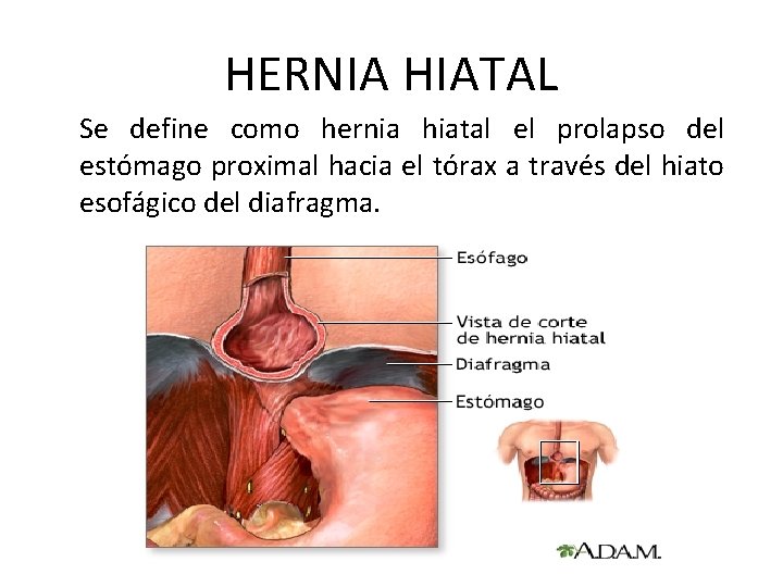 HERNIA HIATAL Se define como hernia hiatal el prolapso del estómago proximal hacia el