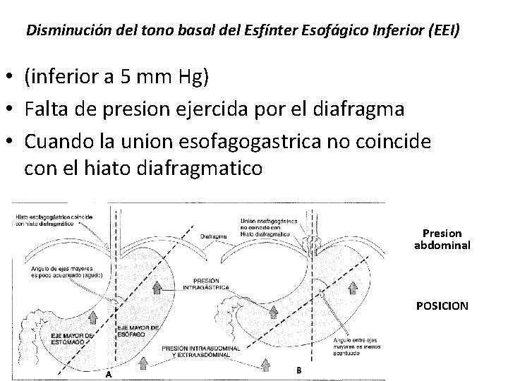 Disminución del tono basal del Esfínter Esofágico Inferior (EEI) • (inferior a 5 mm