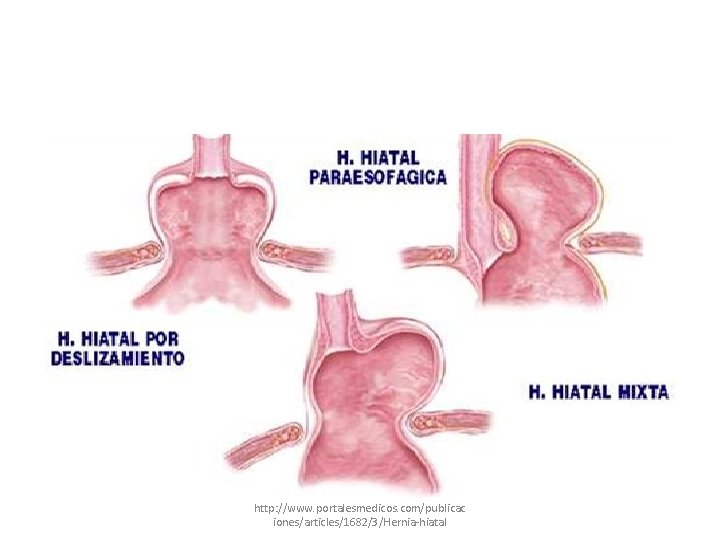 http: //www. portalesmedicos. com/publicac iones/articles/1682/3/Hernia-hiatal 