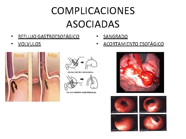 COMPLICACIONES ASOCIADAS • REFLUJO GASTROESOFÁGICO • VOLVULOS • SANGRADO • ACORTAMIENTO ESOFÁGICO 