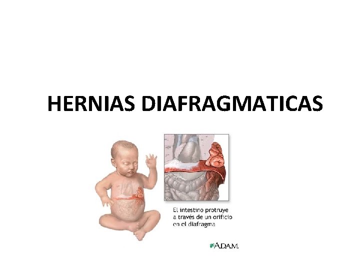 HERNIAS DIAFRAGMATICAS 