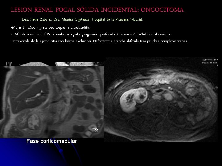 LESION RENAL FOCAL SÓLIDA INCIDENTAL: ONCOCITOMA Dra. Irene Zabala. , Dra. Mónica Cigüenza. Hospital