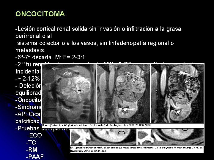 ONCOCITOMA -Lesión cortical renal sólida sin invasión o infiltración a la grasa perirrenal o