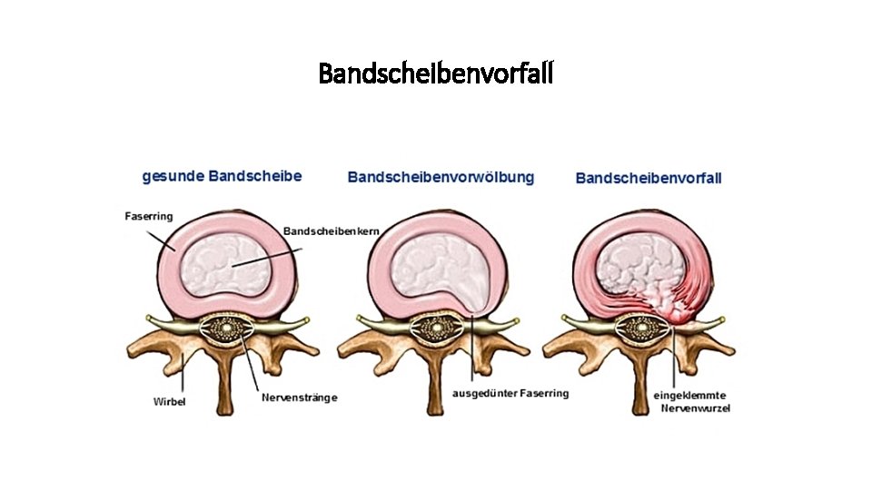 Bandscheibe Drückt Auf Rückenmark Hws slidetodoc.com