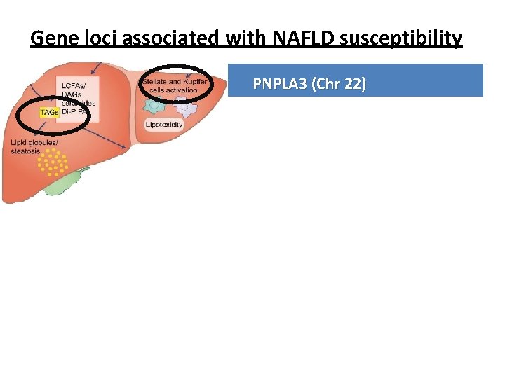 Gene loci associated with NAFLD susceptibility Gene PNPLA 3 (Chr 22) Normal Code for