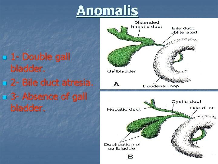 Anomalis n n n 1 - Double gall bladder. 2 - Bile duct atresia.