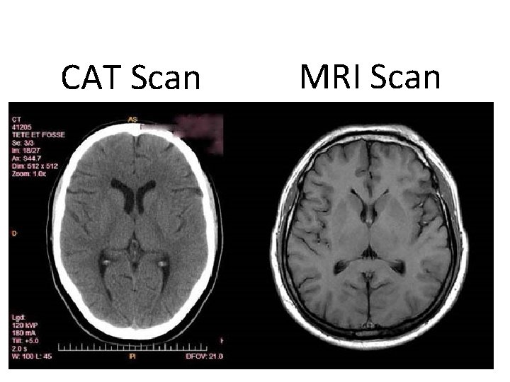 CAT Scan MRI Scan 