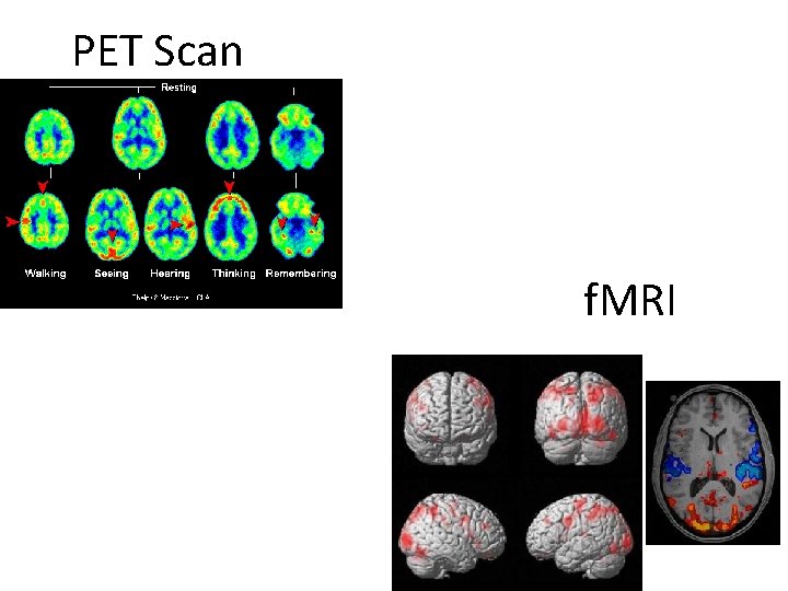 PET Scan f. MRI 