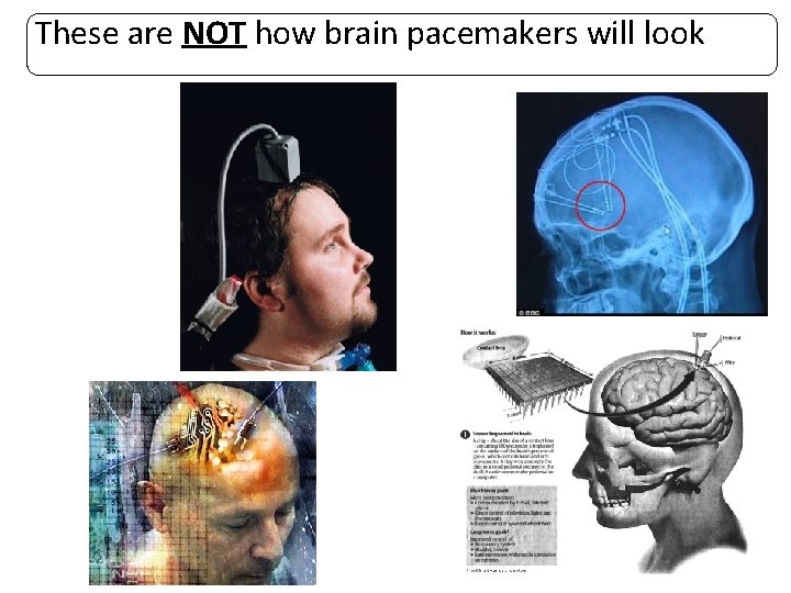 These are NOT how brain pacemakers will look 