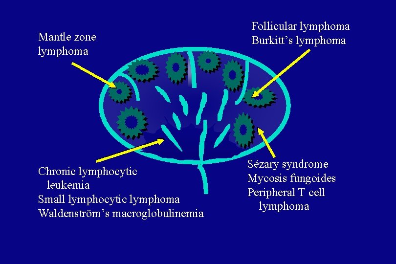 Mantle zone lymphoma Chronic lymphocytic leukemia Small lymphocytic lymphoma Waldenström’s macroglobulinemia Follicular lymphoma Burkitt’s