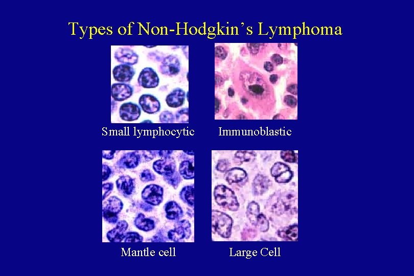 Types of Non-Hodgkin’s Lymphoma Small lymphocytic Immunoblastic Mantle cell Large Cell 