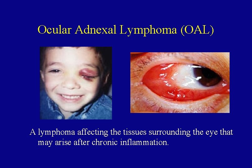 Ocular Adnexal Lymphoma (OAL) A lymphoma affecting the tissues surrounding the eye that may