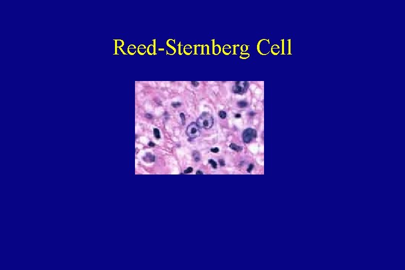 Reed-Sternberg Cell 