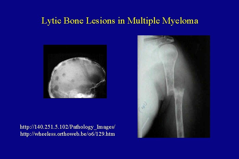 Lytic Bone Lesions in Multiple Myeloma http: //140. 251. 5. 102/Pathology_Images/ http: //wheeless. orthoweb.