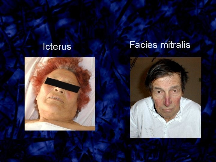 Icterus Facies mitralis 