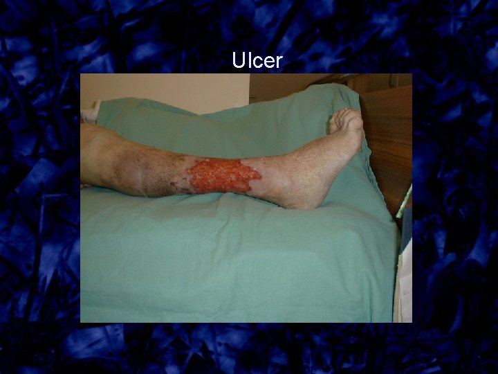 Ulcer 