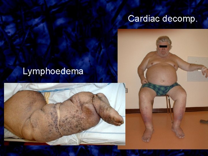 Cardiac decomp. Lymphoedema 