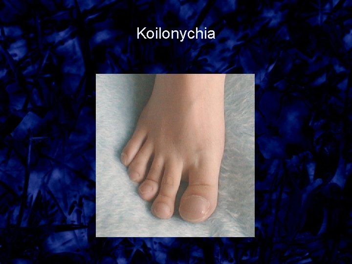 Koilonychia 