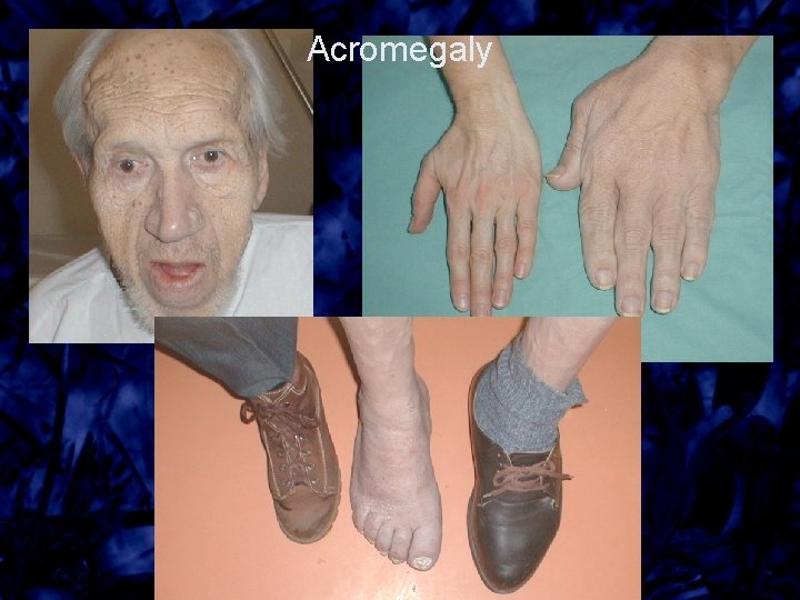 Acromegaly 